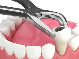 Affordable Tooth Extraction Raleigh NC: Safe and Gentle Care Options