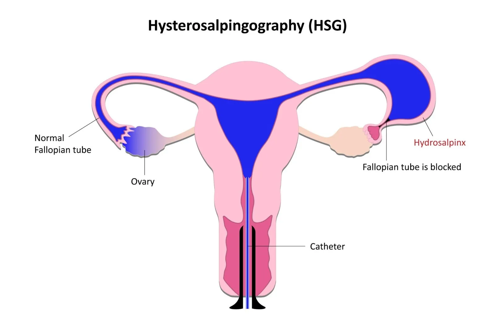 HSG procedure diagram, AI generated
