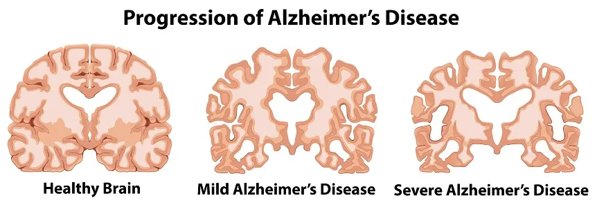 Central nervous system diseases