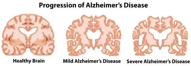 Central nervous system diseases