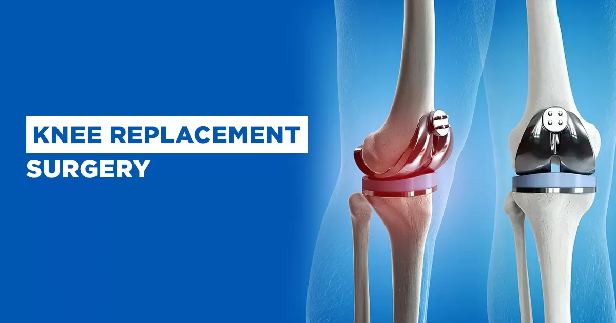 Knee Replacement Surgery: How to Choose the Best Hospital and Surgeon Overseas