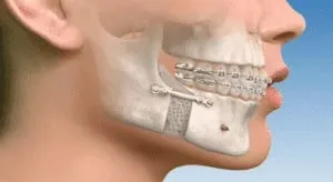How Do Los Angeles, CA Orthodontists Handle Adult Braces Differently?