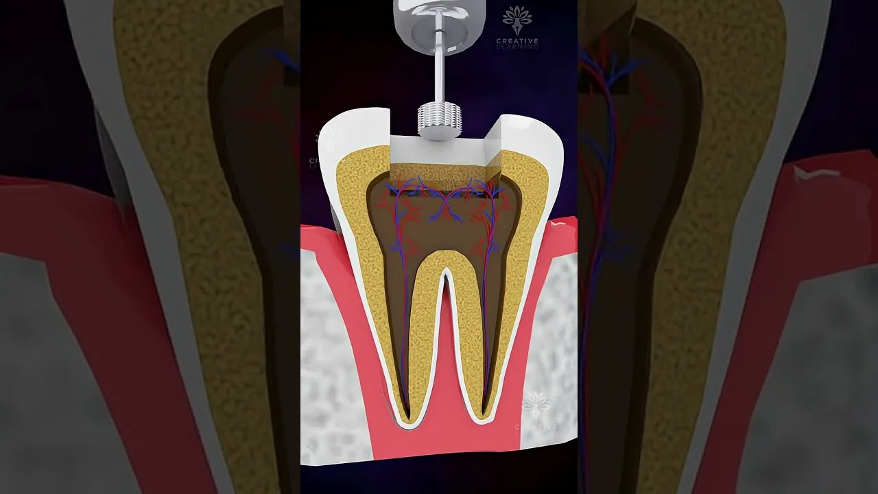 Root Canal Treatment Vs Tooth Extraction Which Is Better