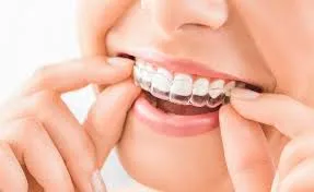 Who Offers Invisible Braces in Seattle?