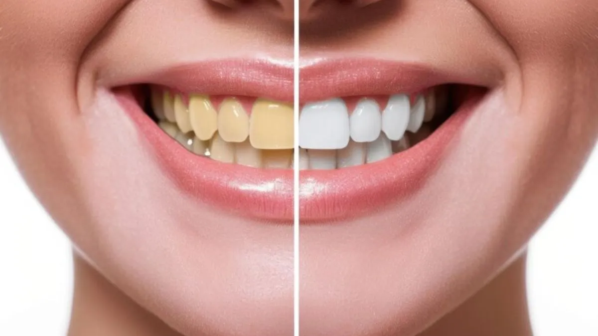 Causes Of Yellow Teeth and How to Get Rid of It