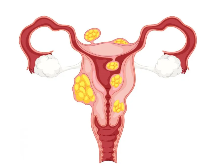 Uterine Fibroids: Causes, Symptoms, and When to Treat