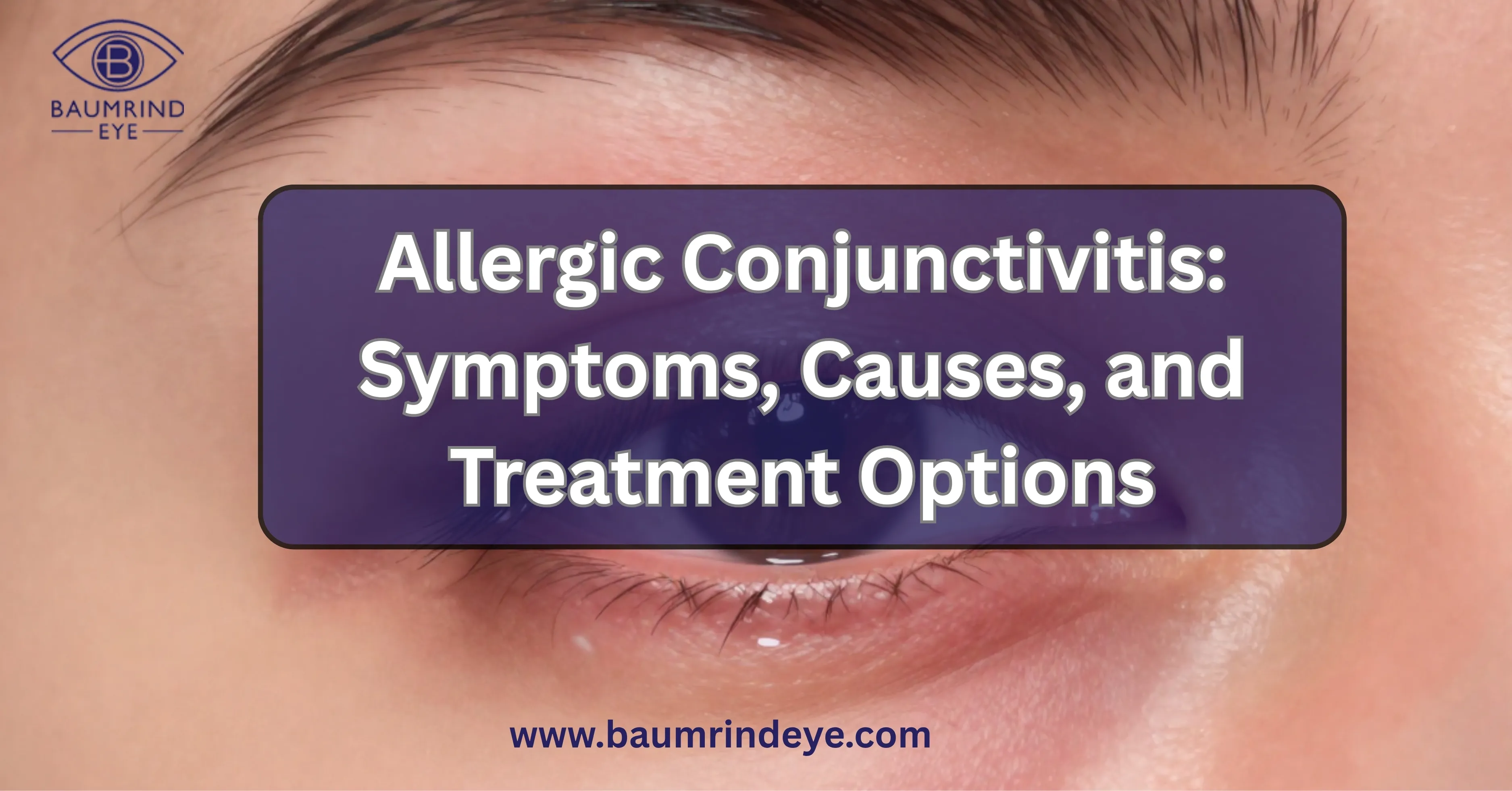 Eye Allergies Explained: Allergic Conjunctivitis Symptoms, Causes & Expert Treatment
