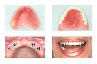 Why Dental Implants Are a Popular Choice for Missing Teeth