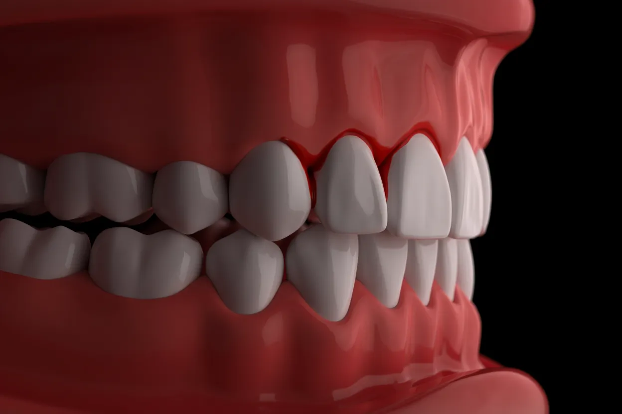 Bleeding Gums: Causes, Treatment, and How to Stop It Naturally