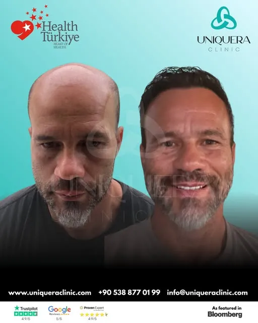 Why Choose Sapphire FUE for Hair Transplant? Expert Guide