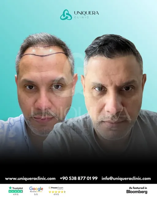Choosing the Best Hair Implant Clinic in Istanbul Turkey