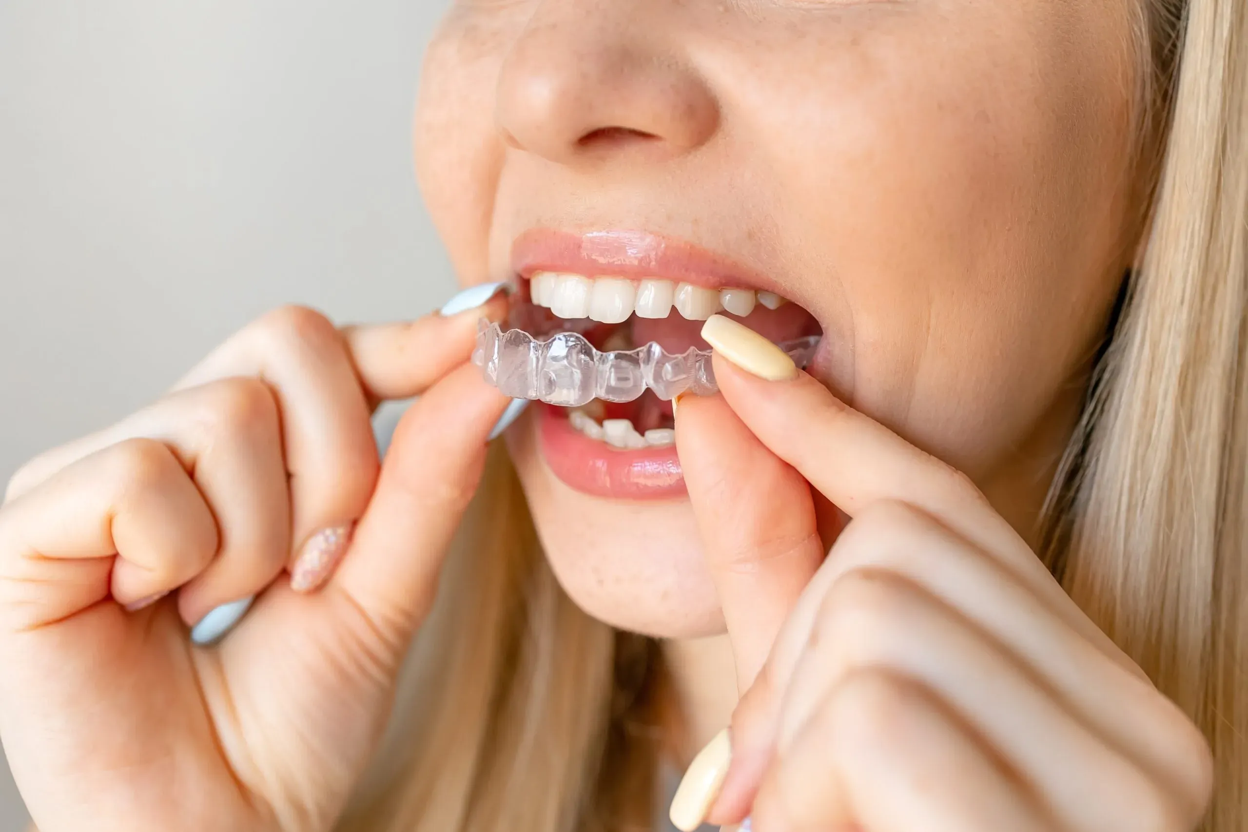 What Is Invisalign Treatment and How Does It Work?