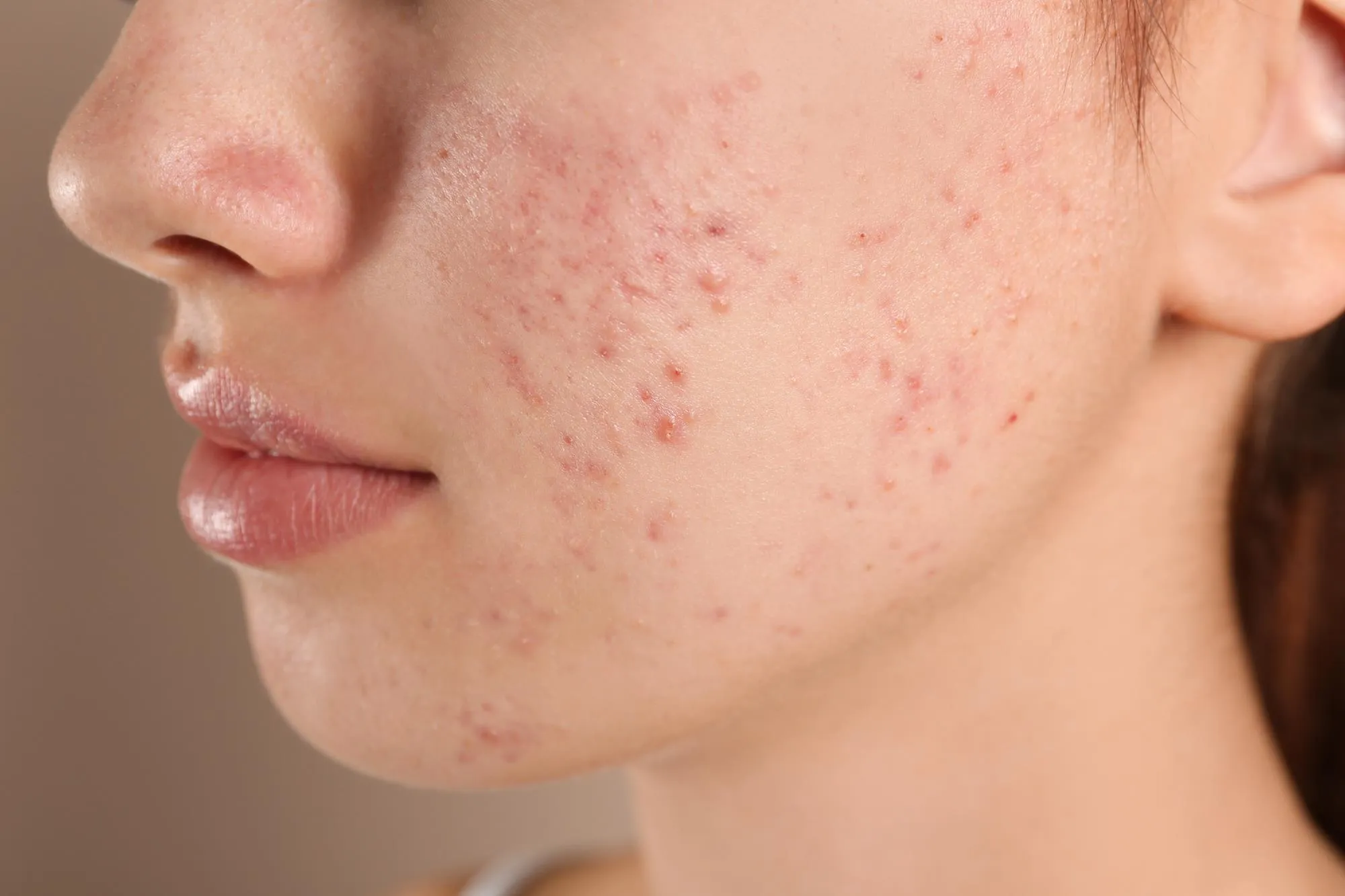 What Is the Best Acne Treatment for Different Skin Types?