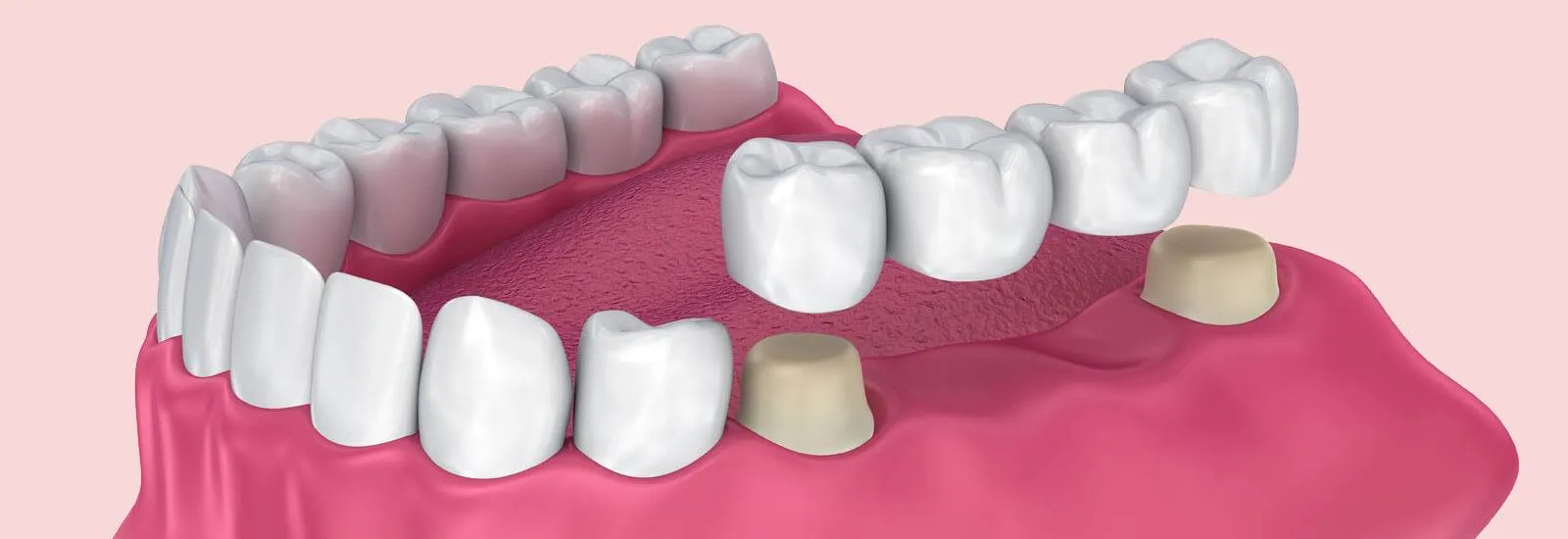 Complete Smile Restoration with Dental Crown & Bridge Treatment in Nizamabad
