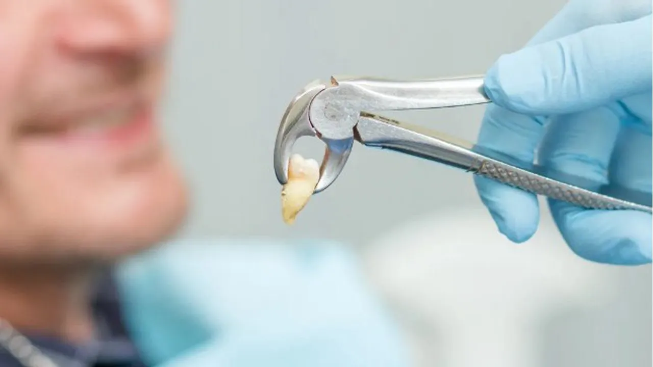 Signs You Need Wisdom Tooth Removal Don’t Ignore These