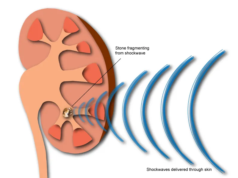 Say Goodbye to Kidney Stones with Lithotripsy Treatment