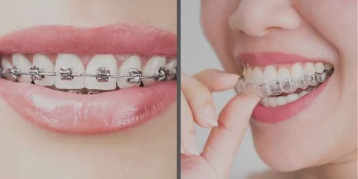 Braces Treatment vs Invisalign Which Option Is Better
