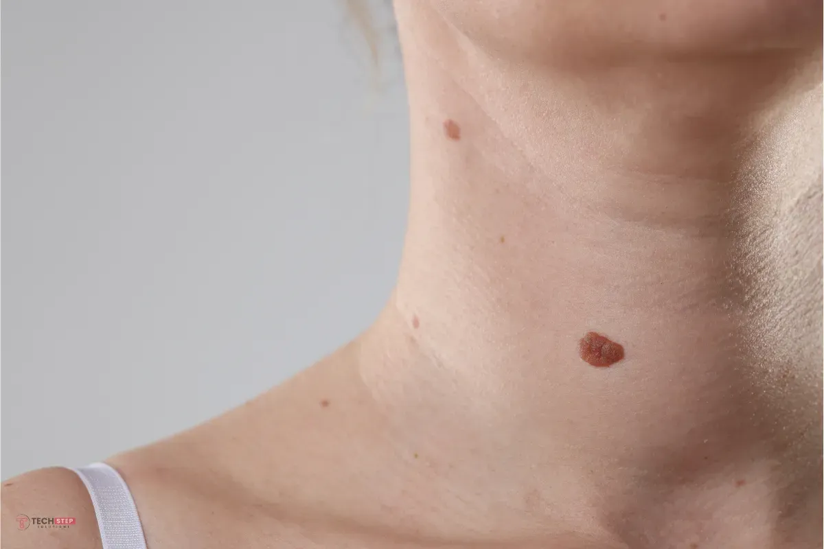 Anus Skin Tag Removal in Houston & Sugar Land: