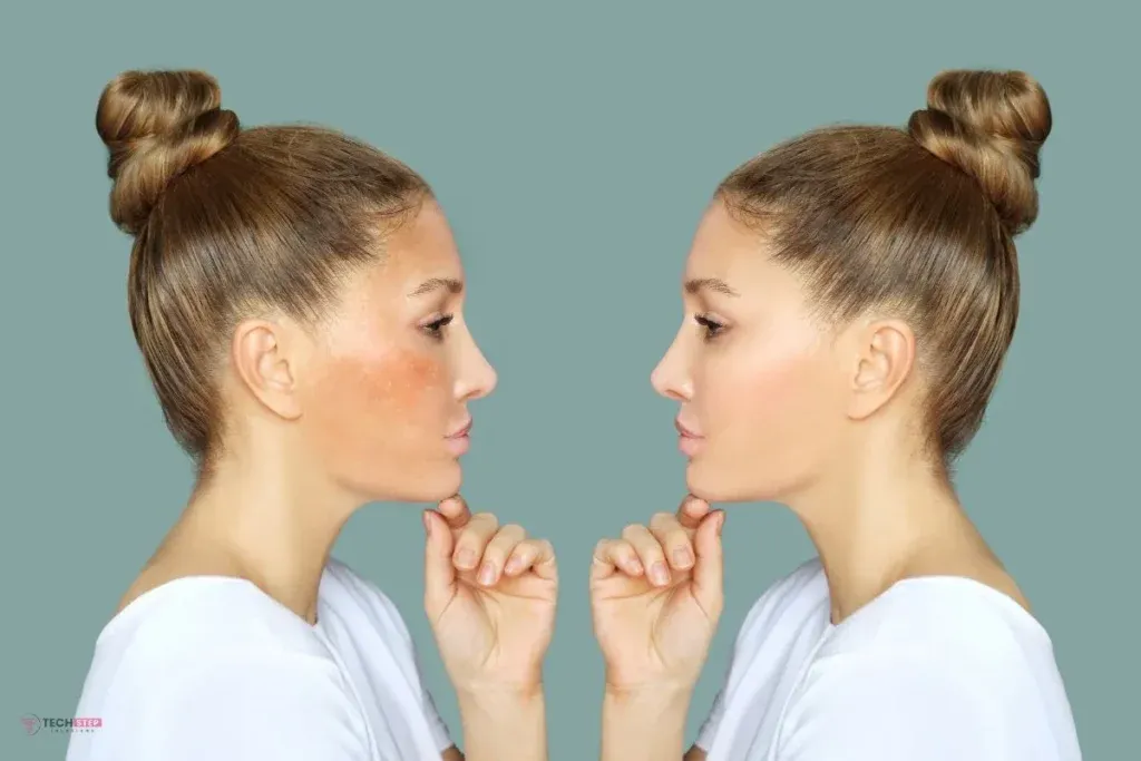 Professional Melasma Treatment Houston Using VI Peel Therapy