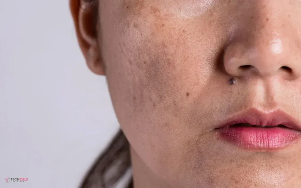 Professional Melasma Treatment Houston Using VI Peel Therapy