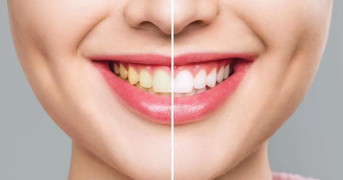 Dental Clinic Kings Langley: Tooth Whitening and Dental Care Guide