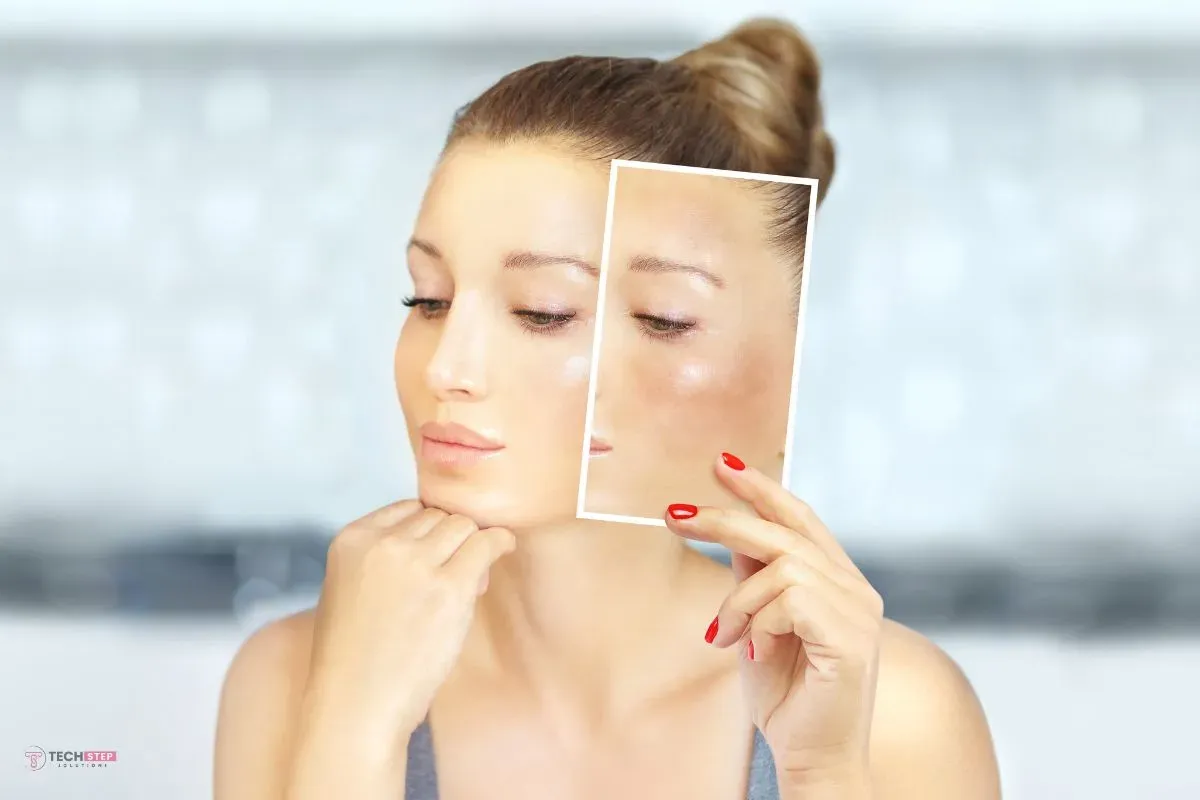 Hyperpigmentation Treatment Houston: Reduce Dark Spots and Uneven Tone