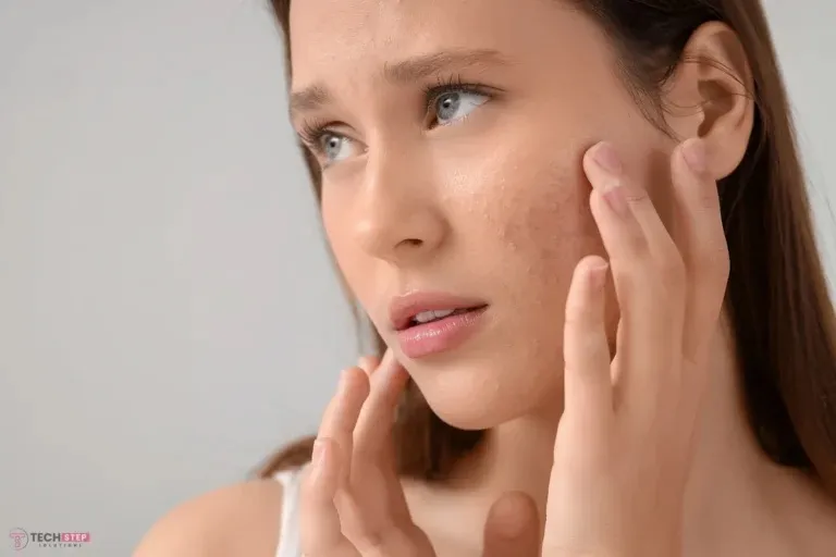 Effective Acne Treatment Houston with Laser Genesis