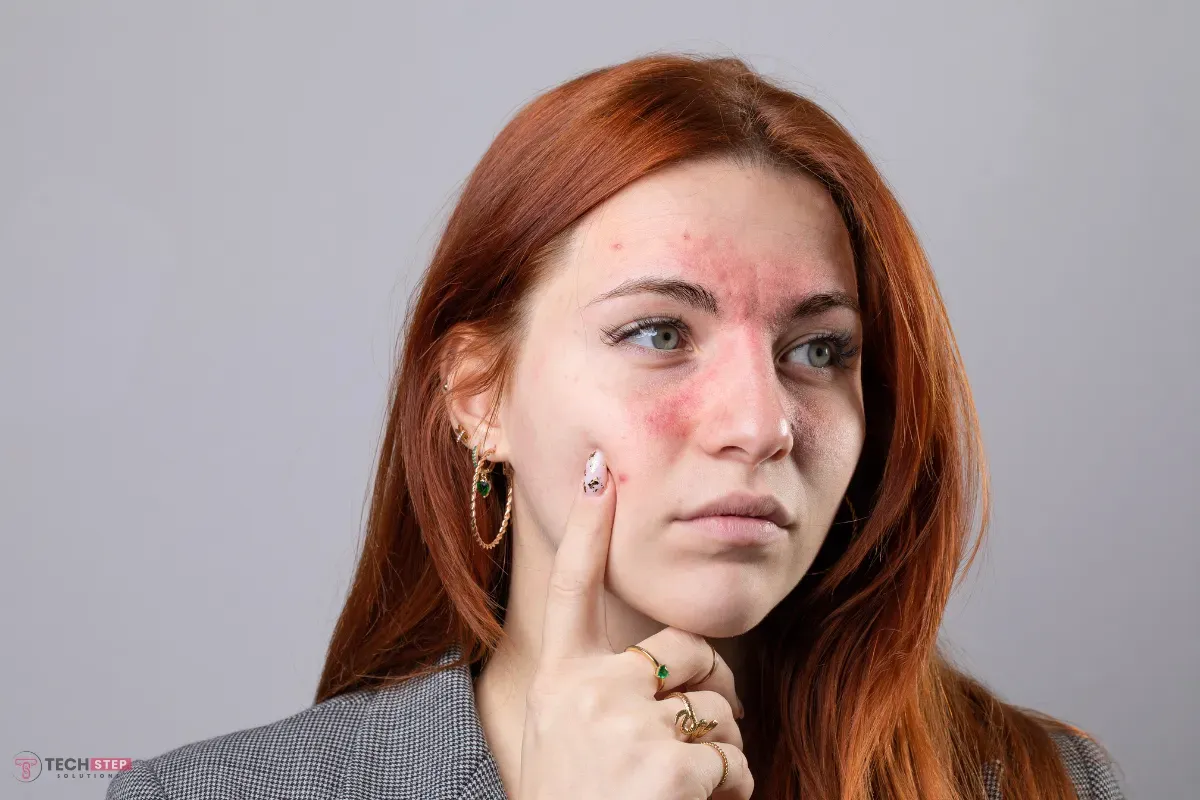 Expert Rosacea Treatment Houston TX for Long-Term Redness Control