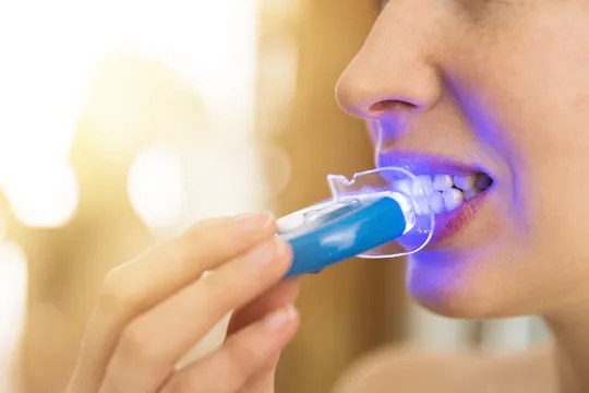 Professional Teeth Whitening in Peterborough – Brighter Smiles Today
