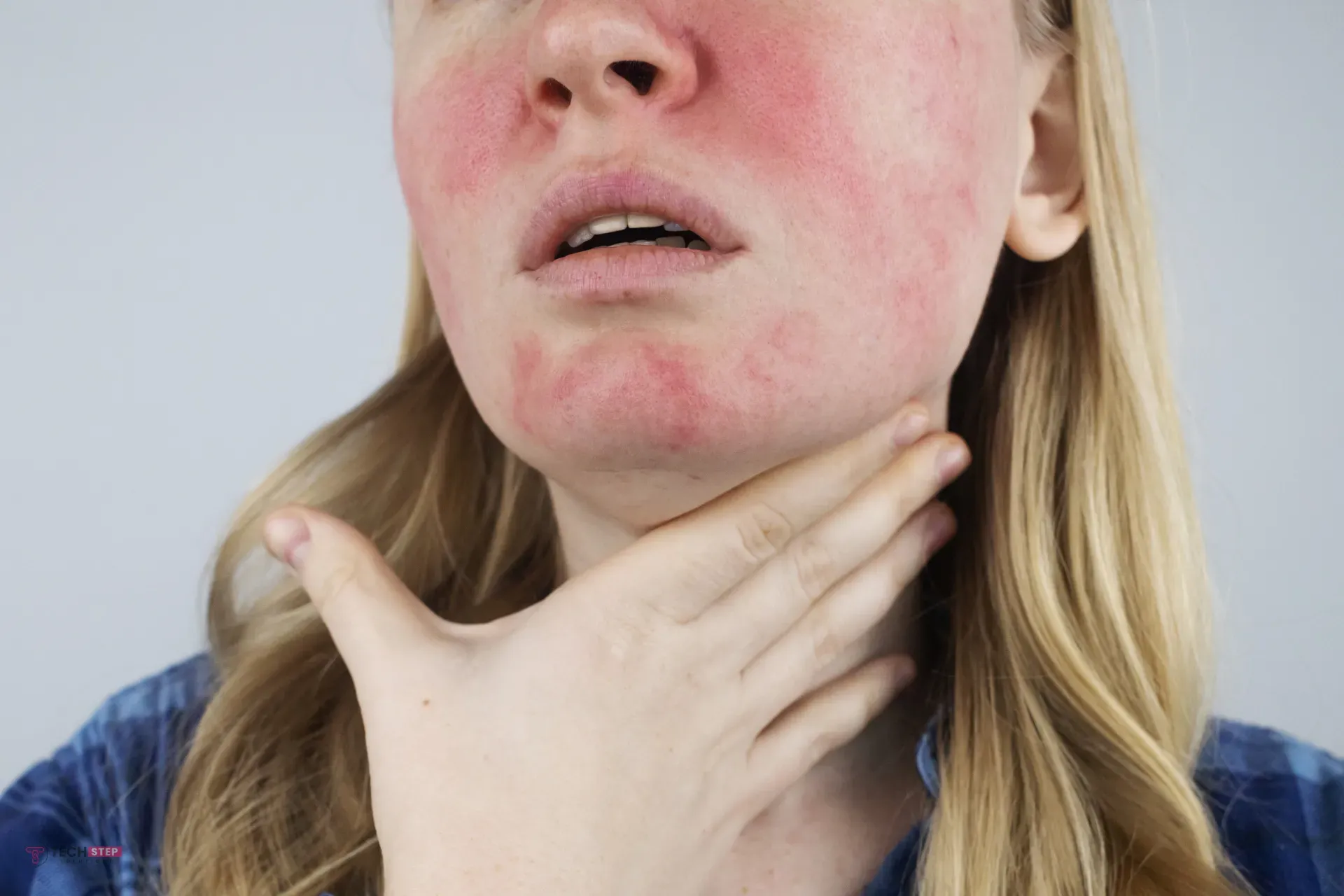 How to Get Rid of Rosacea Permanently: