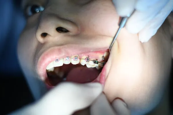 Braces Treatment Cost for Kids and Adults Complete Guide