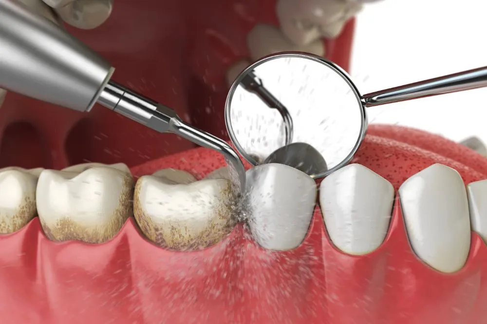 Teeth Cleaning Before and After: What Results Can You Expect?