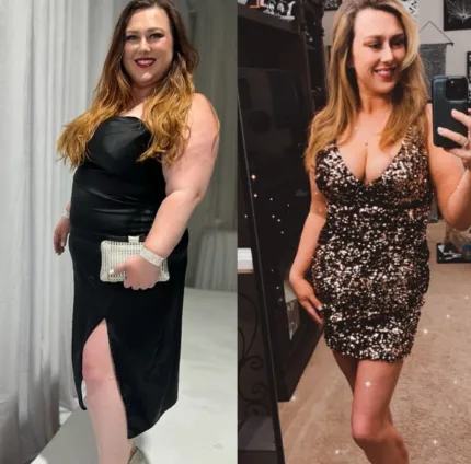 Bariatric Surgery Before and After: What Your Weight Loss Journey Really Looks Like