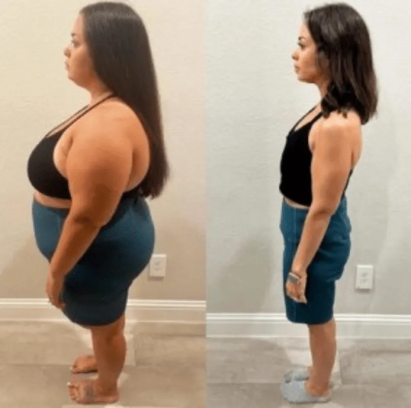 Bariatric Surgery Before and After: What Your Weight Loss Journey Really Looks Like