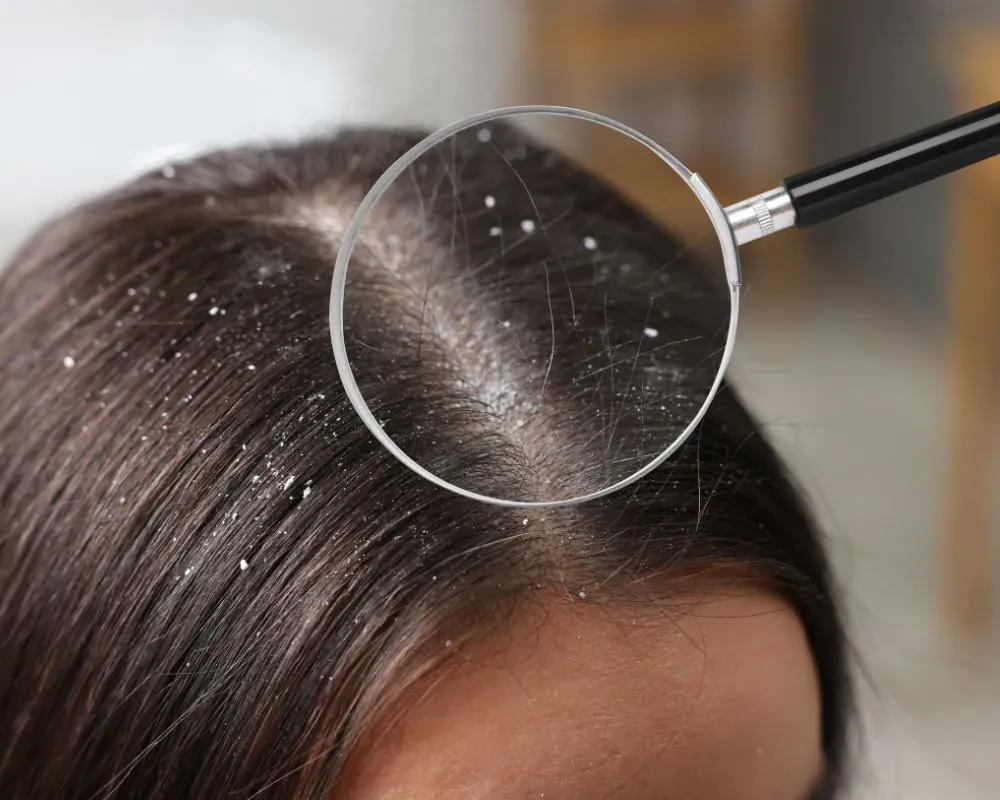 Best Dandruff Treatment in Gurgaon: Expert Guide