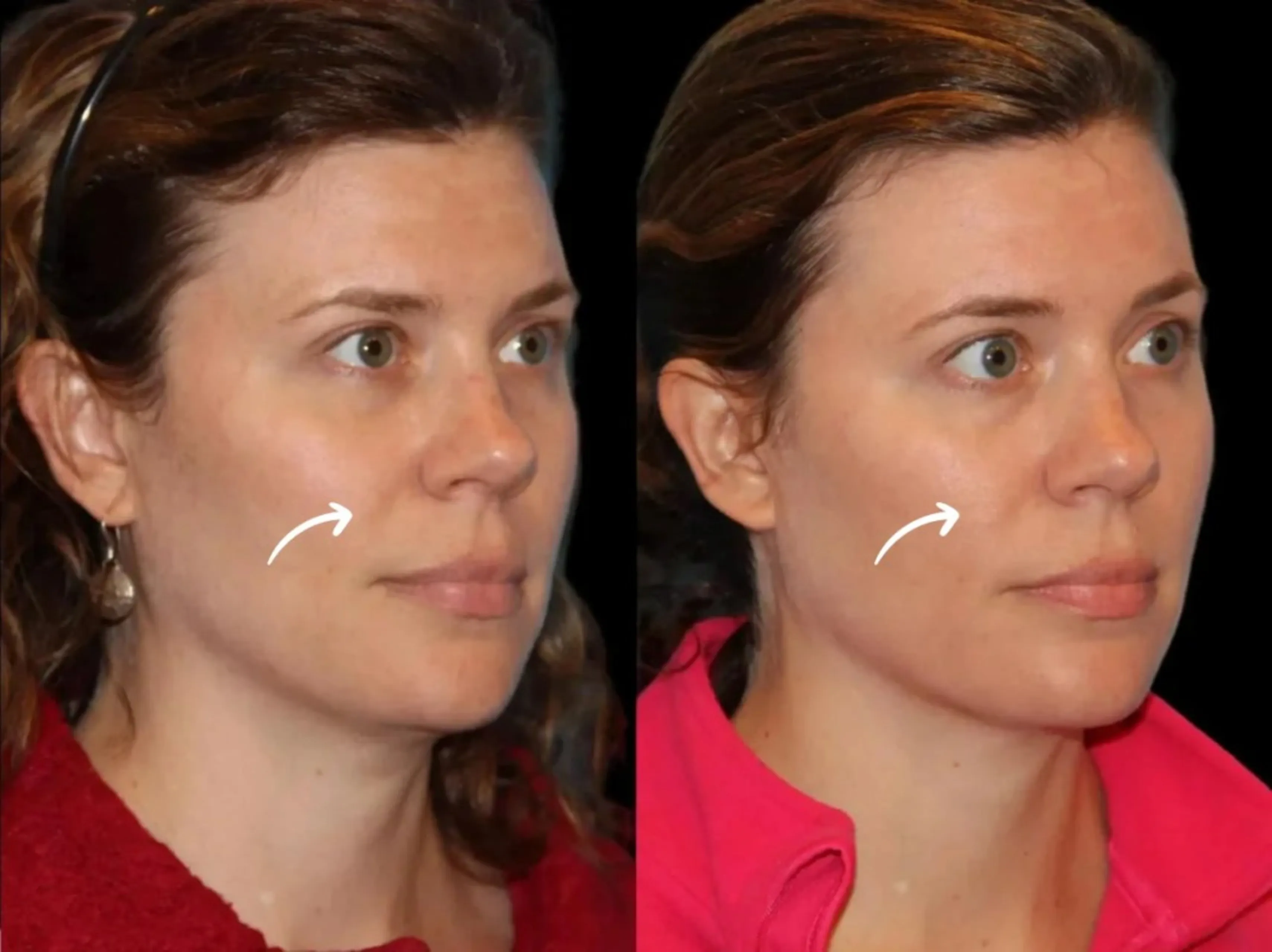 Sculptra Treatments in Dubai for Cleavage Lines