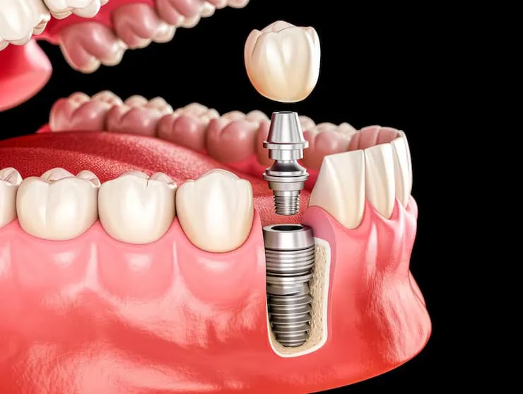 Risks and Benefits of Same Day Implants in Derby