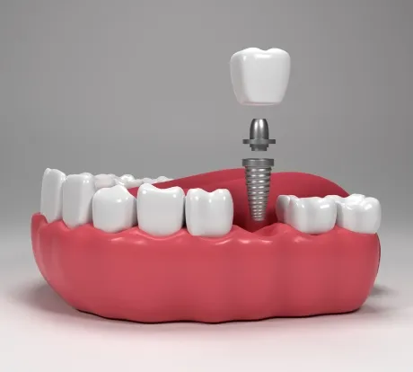 Worried About Tooth Loss? Explore Dental Implants in Dhakoli as a Permanent Fix
