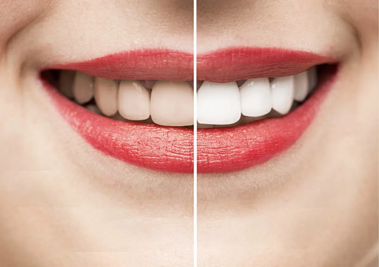 Redefine Your Smile with Advanced Teeth Whitening Solutions