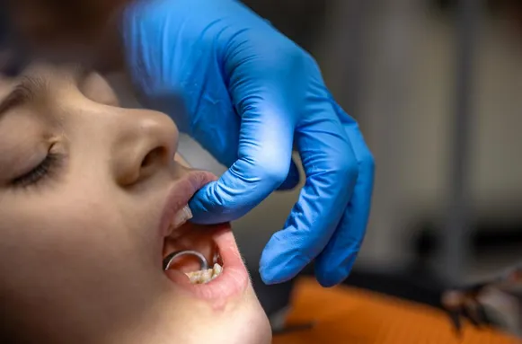 Cracked Teeth Treatment: Restore Strength and Protect Your Smile