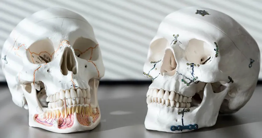 Jaw Surgery in India: Complete Guide for Patients
