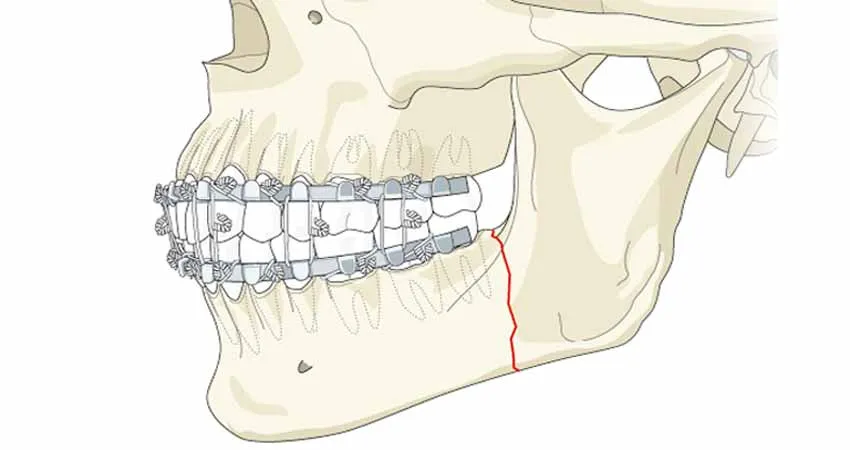 Jaw Surgery in India: Complete Guide for Patients