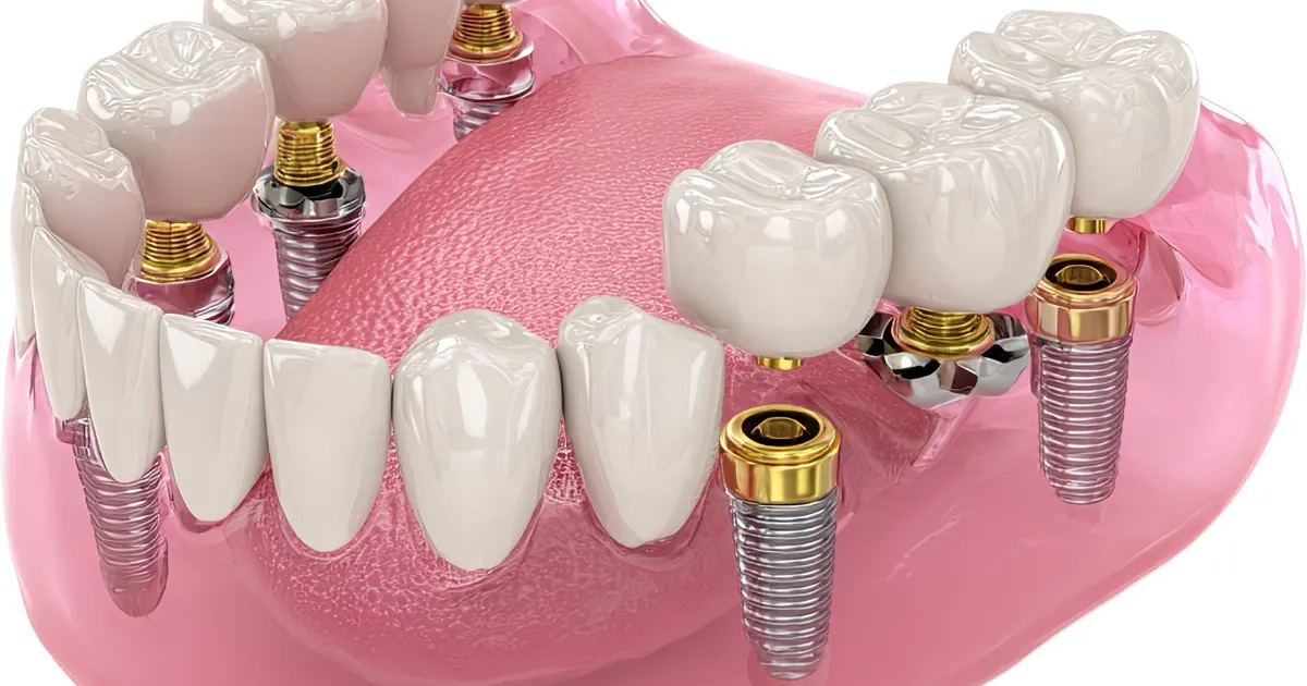 Dental Implants Treatment in Lahore – Book an Appointment Now