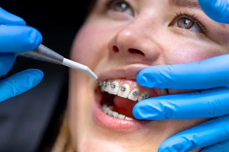 Expert Orthodontic Care: Why Choose A Specialist For Braces Or Aligners?