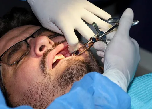 Bye – Bye Wisdom Teeth: Simple Guide to Pain Free Removal