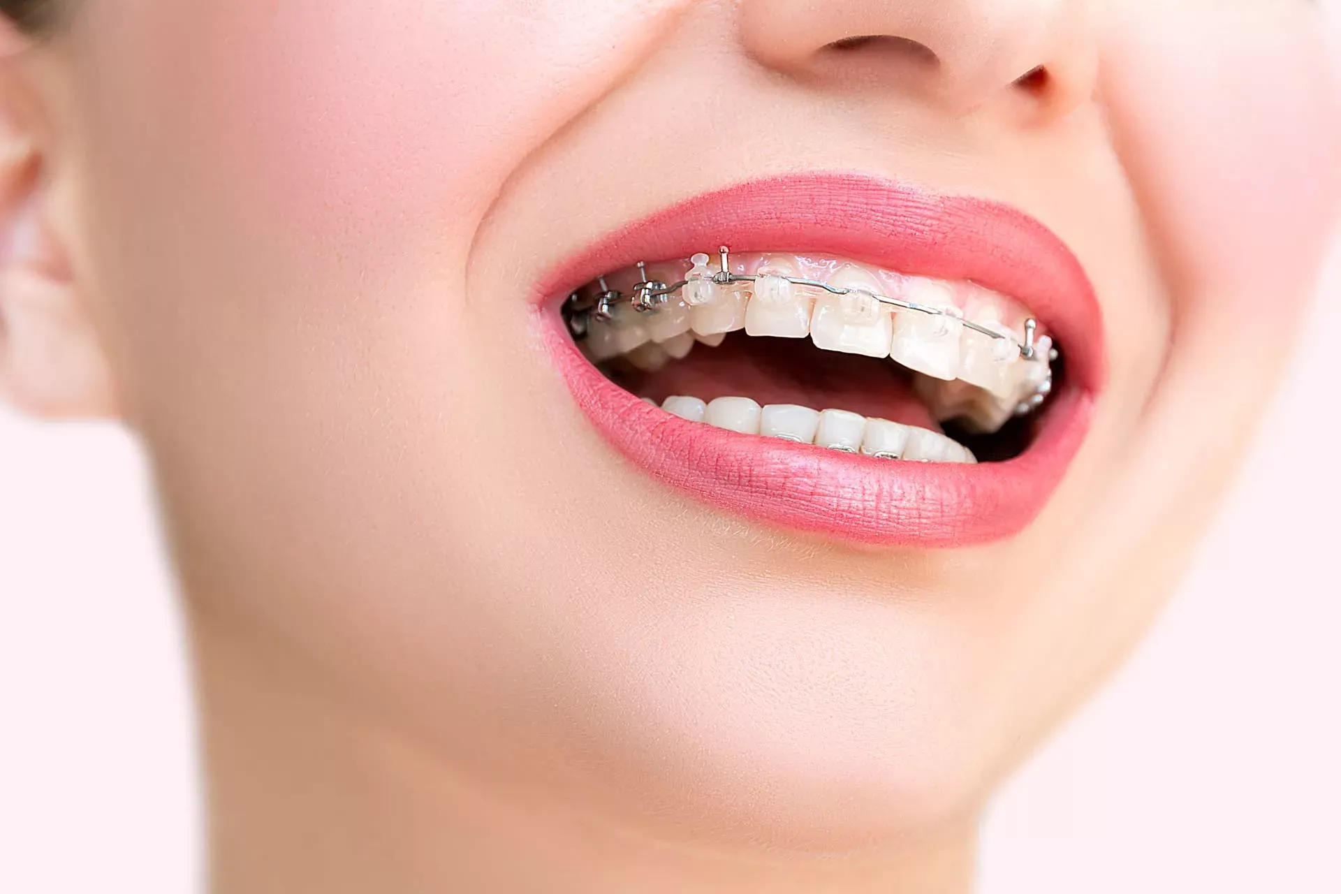 Understanding the Cost of Braces Treatment in Parel Mumbai