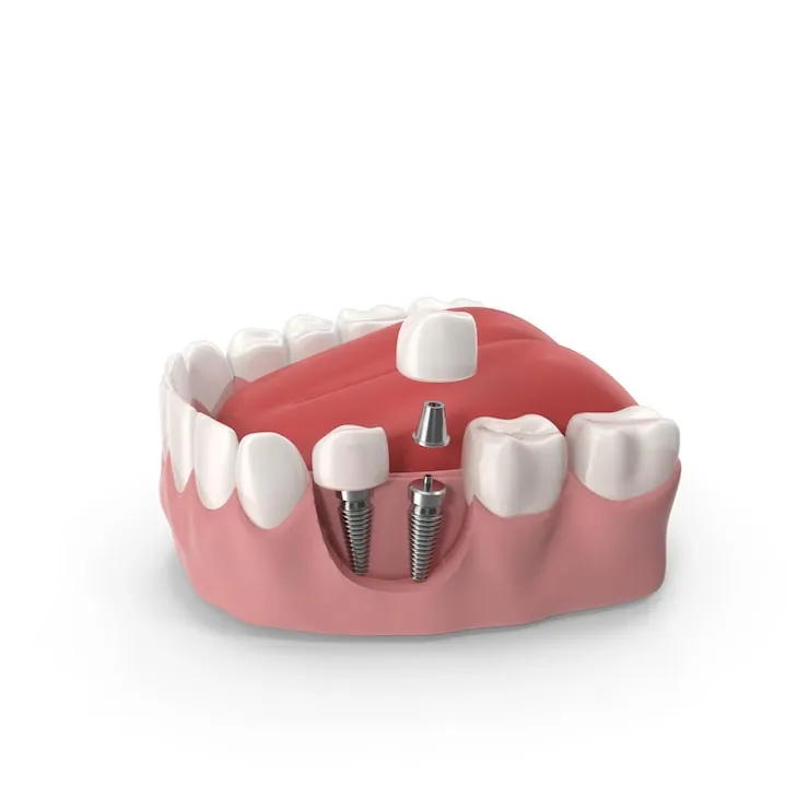 Are Dental Implants Safe? Choosing A Trusted Clinic In Chennai