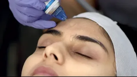 What Skin Concerns Can Microdermabrasion Effectively Improve?