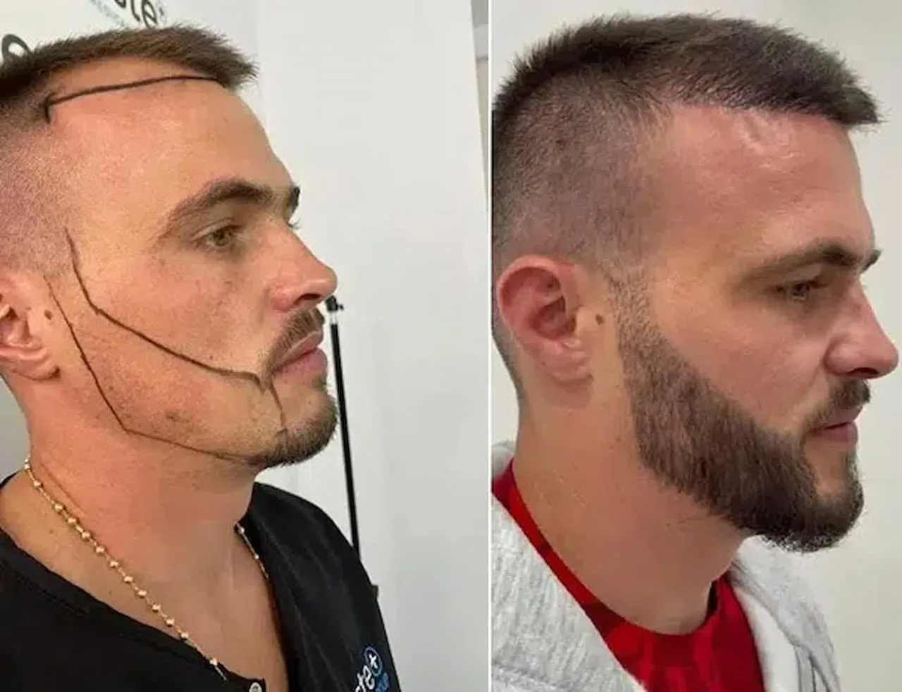 Struggling with Patchy Facial Hair? Discover Beard Transplants in Leicester