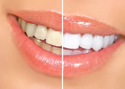 How to Remove Yellow Stains from Teeth Permanently